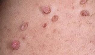 Causes of papilloma on the body