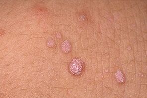 Causes of papilloma on the body