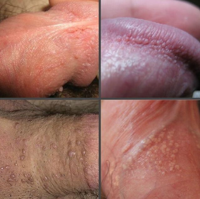 What kind of papilloma on the penis looks like
